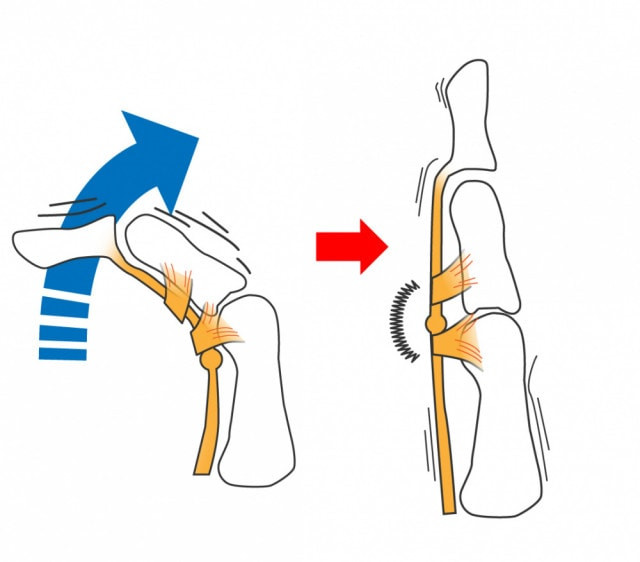 ばね指　説明画像
